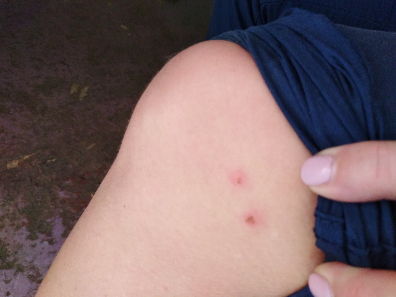 bugs bite