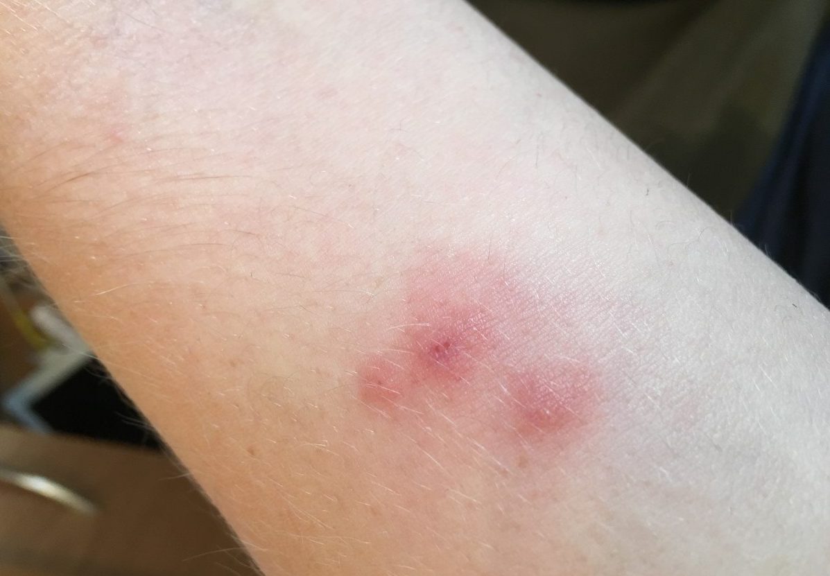 flea bite