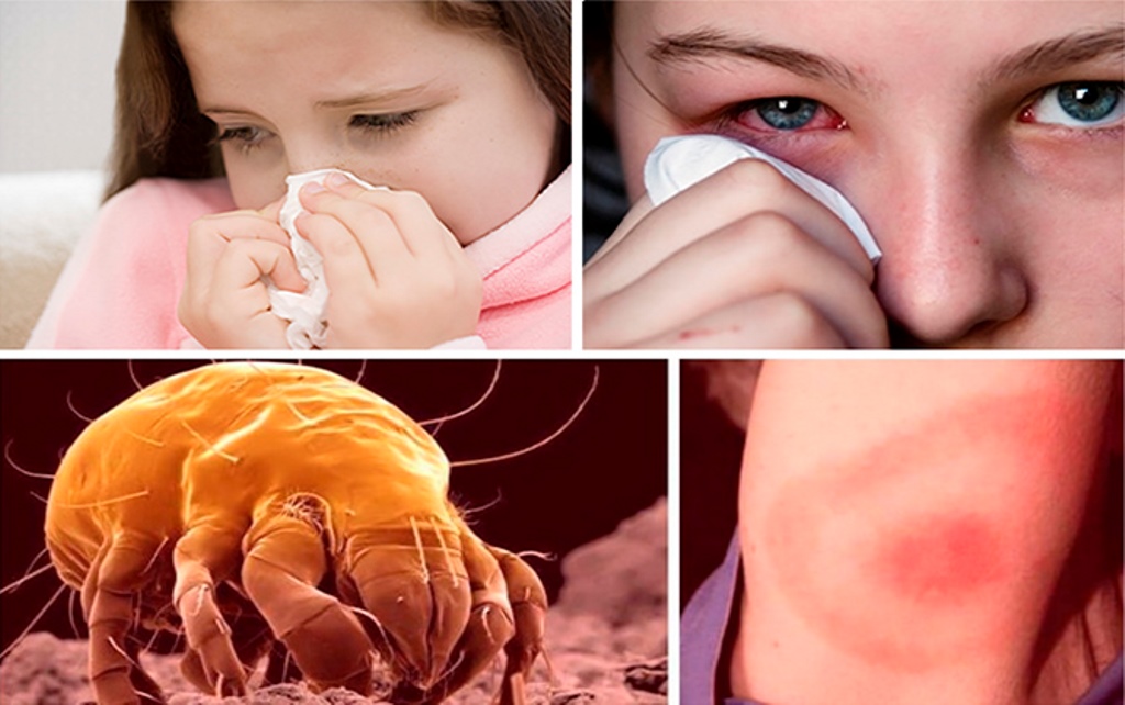 dust mite allergy