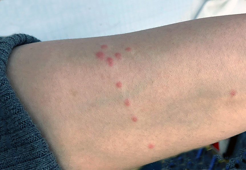 bedbug bites photos